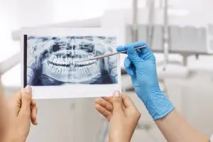 implant-insurance