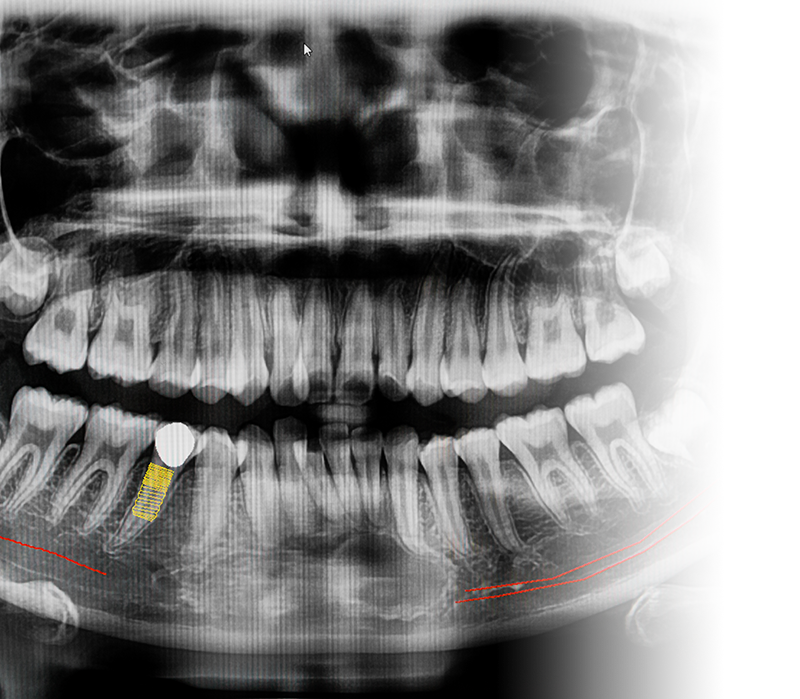 implant-x-ray