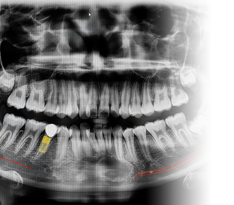 implant-x-ray