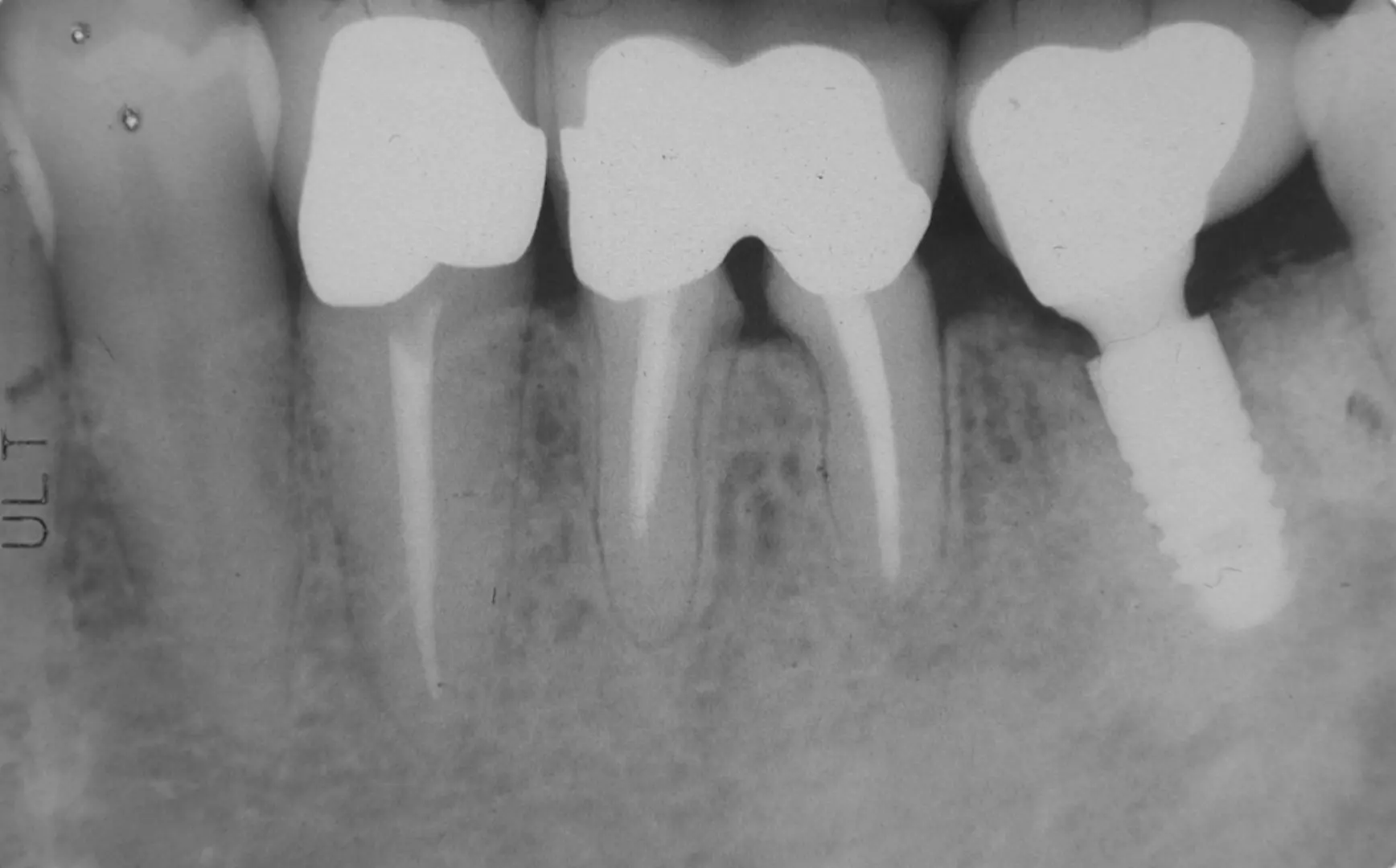 perio-implant-case6