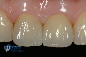 rootcanal-case1-5