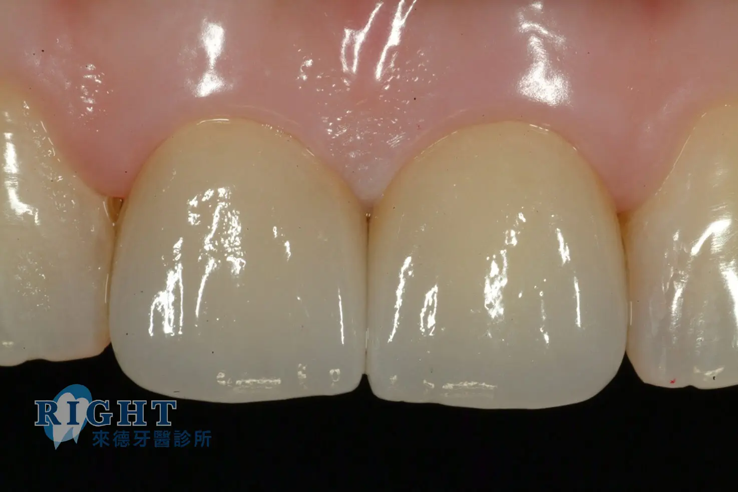Read more about the article 牙根管假牙修復-案例1