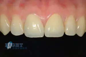 rootcanal-case2-2