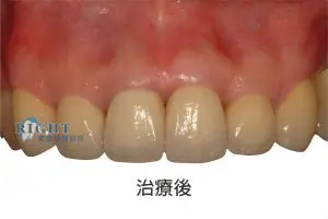 rootcanal-case4-3