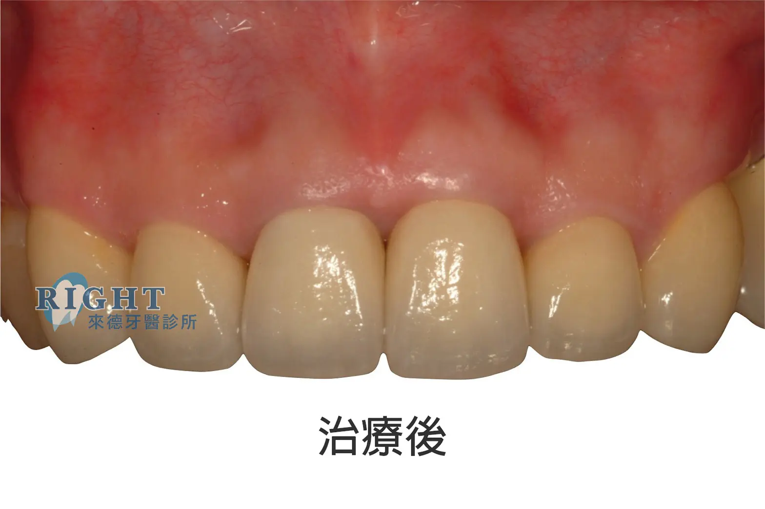 Read more about the article 牙根管假牙重建-案例2