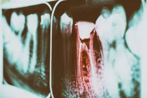 pain-of-tooth-decay-on-teeth-x-ray-TP5AF56 (1)