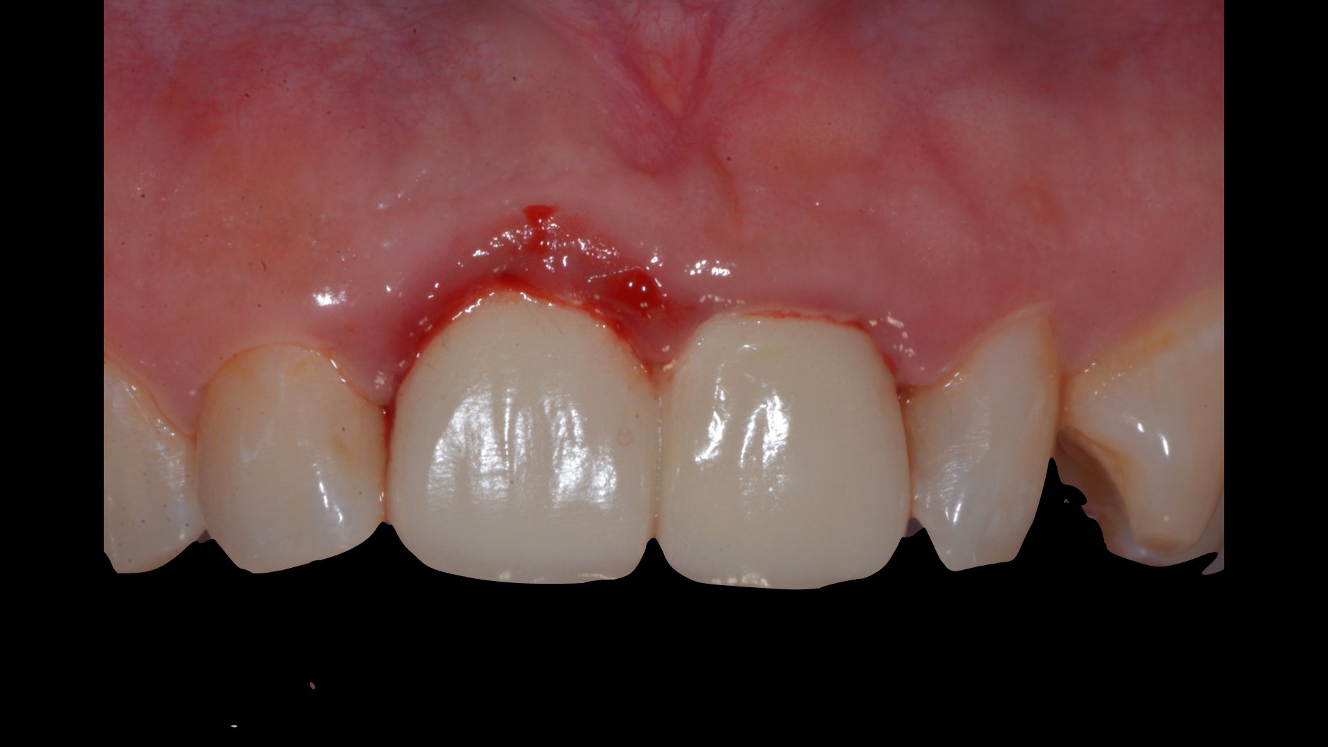 假牙常見的牙齦發炎問題